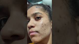 Tretinoin cream 0025 before and after 1 YEAR OF TRETINOIN tretinoin shortsfeed tretinoincream [upl. by Palmira]