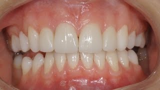 Виниры без обточки зубов Люминиры Veneers without teeth preparation Carillas Dentales 牙齿镶 [upl. by Judah]