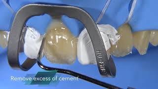 Veneer cementation with the resin cement G CEM LinkForce [upl. by Gradey]