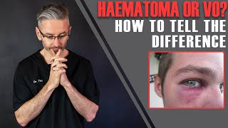 Haematoma Or Vascular Occlusion How To Tell The Difference Aesthetics Mastery Show [upl. by Thursby103]