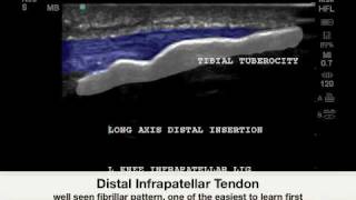 Knee Infrapatellar Enthesopathy  Sonosite Case Study [upl. by Isabeau164]