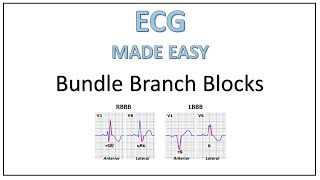 ECG  Bundle Branch Blocks  Trick to remember [upl. by Naeruat]