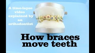 BRACES EXPLAINED How Teeth Move  Braces Work [upl. by Felizio]