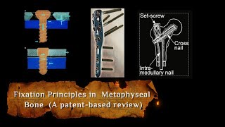 Metaphyseal Bone Fixation Principles What Everyone Needs to Know [upl. by Ingmar]