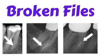 Endodontic Instrument fracture  Separated File Management of Broken Files Bypass Technique [upl. by Artemas]