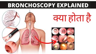 bronchoscopy Explained in Hindi क्या होता है [upl. by Hak640]