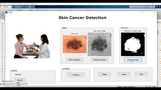 skin cancer detection [upl. by Clarisse]