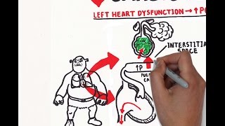 Pulmonary edema USMLE step 1 [upl. by Avenej300]