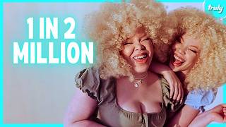 Identical Twins With Albinism Are 1 In 2 Million  BORN DIFFERENT [upl. by Blaine]