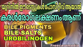 Bilirubin test in urine Bile pigments  Bile salt  Urobilinogen liver disease urine [upl. by Zoe268]