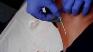 How to Start an External Jugular IV [upl. by Enitsenre]