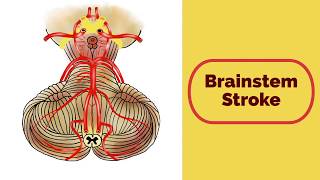 Brainstem Stroke Syndromes [upl. by Abad]