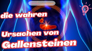 Gallensteine  das solltest Du wissen [upl. by Nylia432]