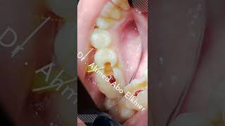 Single Visit Endodontic Treatment الكربولة endodontics dental [upl. by Sibell265]