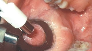 Biopsia de la mucosa bucal T26 [upl. by Irv]