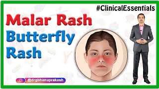 Malar rash Butterfly rash Dermatology  Clinical essentials [upl. by Garbe448]