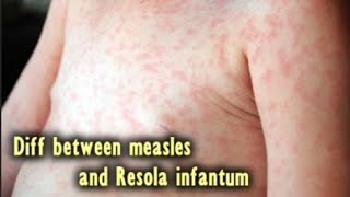 Whats The Difference Between Measles And Roseola [upl. by Jonme822]