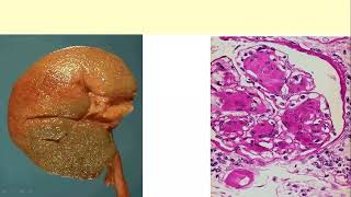 Arteriosclerosis arteriolosclerosis and vascuitis [upl. by Olivie412]