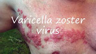 How to Pronounce Varicella zoster virus [upl. by Kally]