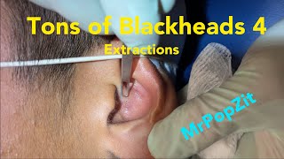 Tons of blackheads 4 Acne extractions Blackheads whiteheads milia Nose ears lips Pore dirt [upl. by Nossah]