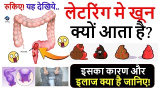 लेटरिंग मे खून क्यों आता है इसके कारणजाँच और इलाज देखिये  Blood In Stool  Gyanvid Nuskhe [upl. by Iorgo180]