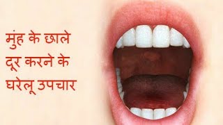 1 घंटे में मुंह और जीभ के छाले ठीक करने के लिए घरेलु उपाय  Home Remedy for Mouth amp Tongue Ulcers [upl. by Alice130]