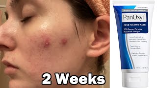 I tried panoxyl face wash for 2 weeks to clear my acne [upl. by Etnaud]