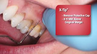 XTIP Intraosseous Anesthetic Delivery System [upl. by Hsetirp]