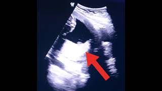 Low placenta in pregnancy  placenta previa  Anterior posterior placenta  Low lying placenta usg [upl. by Arch354]