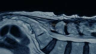 PainExam US Guided Ganglion Impar Block Coccygodynia Pelvic amp Perineal Pain David Rosenblum MD [upl. by Schram]