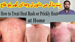 Prickly Heat Treatment  Skin Rash  Red Skin Rash  Miliaria Rubra  Itchy Rash  Sun Allergy [upl. by Normy]