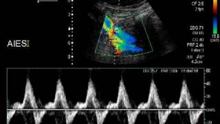 aortic dissection [upl. by Attikram]