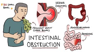 Intestinal Obstruction  Small Bowel Obstruction vs Large Bowel Obstruction [upl. by Schiro]