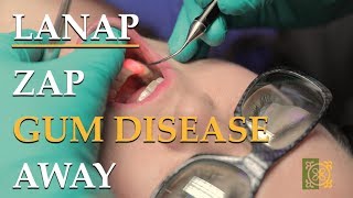 LANAP  Laser alternative to traditional periodontal surgery [upl. by Kerat]