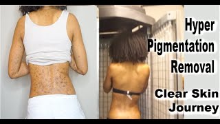 UPDATE What Happened To My SKIN  UVB Phototherapy for hyper pigmentation amp dark spots Skin Journey [upl. by Ahseei]