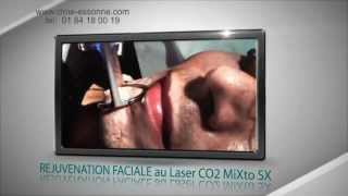 REJUVENATION FACIALE au Laser CO2 Micro Fractionné MiXto SX  CLME Montlhéry Essonne [upl. by Eriha]