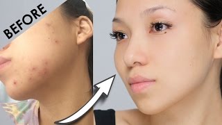 Remove Acne Marks  3 Home Remedies 100 Works With Results [upl. by Meeharb]