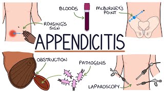 Understanding Appendicitis [upl. by Neitsabes]