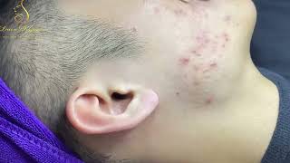 Loan Nguyen Acne Treatment [upl. by Obediah155]