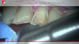 VENEER PREPARATION AND ROOT CANAL OPENING Fotona Lightwalker ErYAG laser [upl. by Ferretti]