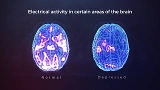 Breakthrough Depression Treatment TMS Therapy At Florida TMS Clinic In The Tampa Bay Area [upl. by Hecklau798]