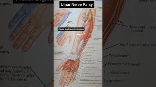 Ulnar Nerve Palsy [upl. by Arand]