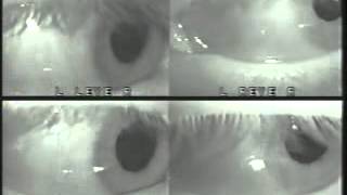 Horizontal Gaze Nystagmus Video [upl. by Wendall]