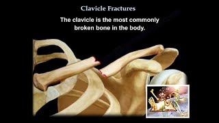 Clavicle Fractures  Everything You Need To Know  Dr Nabil Ebraheim [upl. by Ennalorac]