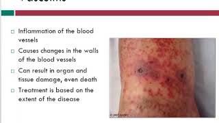 Vasculitis  Info About Vein Problems  WoundEducatorscom [upl. by Trebmer]