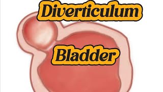 Bladder Diverticulum  Cystitis  Debris [upl. by Ahsyia]