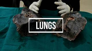 Lungs  gross anatomy [upl. by Tiersten]