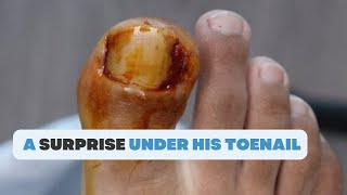 WHAT IS THIS SURPRISE UNDER HIS TOENAIL [upl. by Hosea]