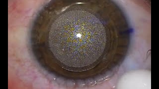 Actual SMILE eye laser vision correction procedure [upl. by Katlaps346]