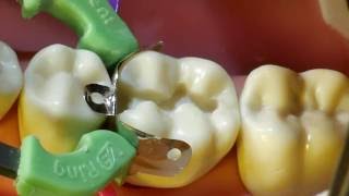 Composite Fill Walkthrough tutorial for 19 MO Approximal Box and Occlusal Fill [upl. by Einama]